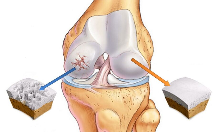 Knee joint osteoarthritis and healthy cartilage