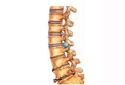 Cervical osteochondrosis development stages