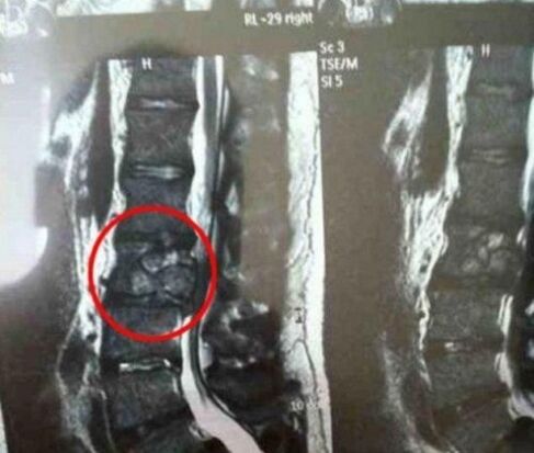 The column tumor in the photo