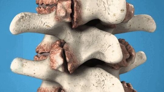Vertebra osteophytes - pathological growths that damage nerves and blood vessels
