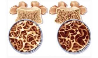 Danger of cervical suction for women