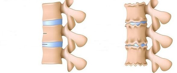 Healthy column and osteochondrosis