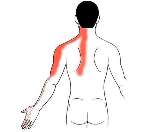 Cervical osteochondrosis as a cause of pain in the finger joints