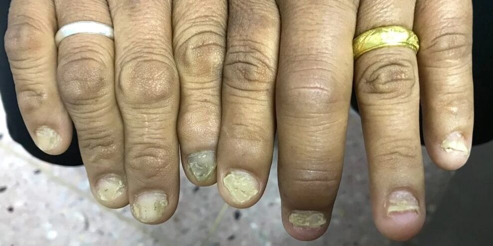 Swelling of the fingers and deformation of the nail plate may indicate the development of psoriatic arthritis
